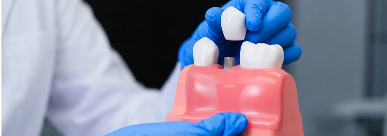 Dental Crown