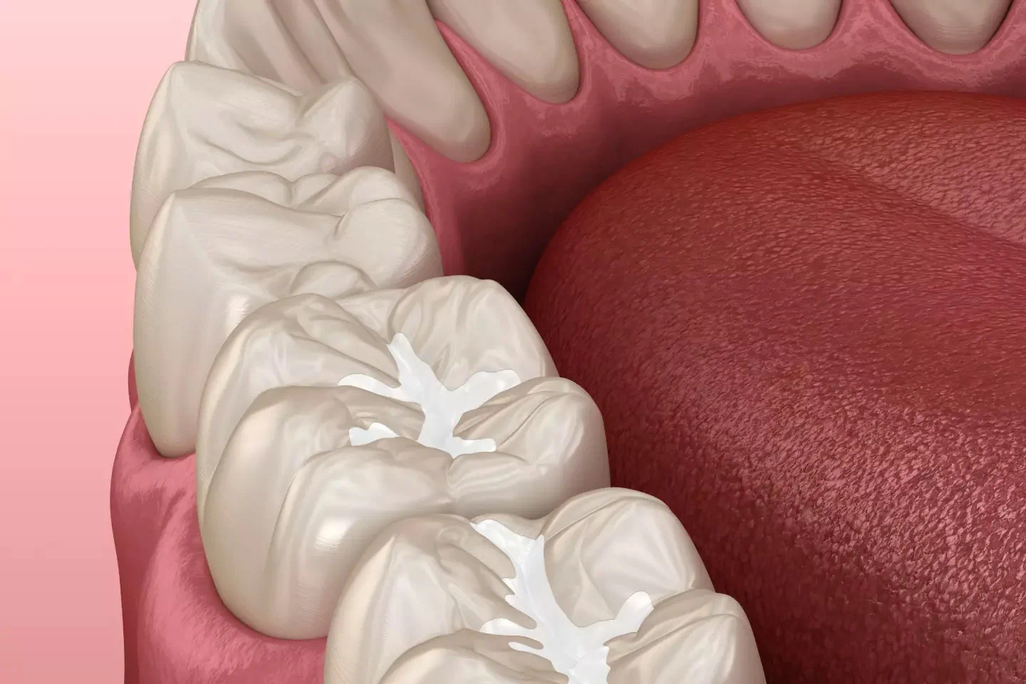 Dental Sealants