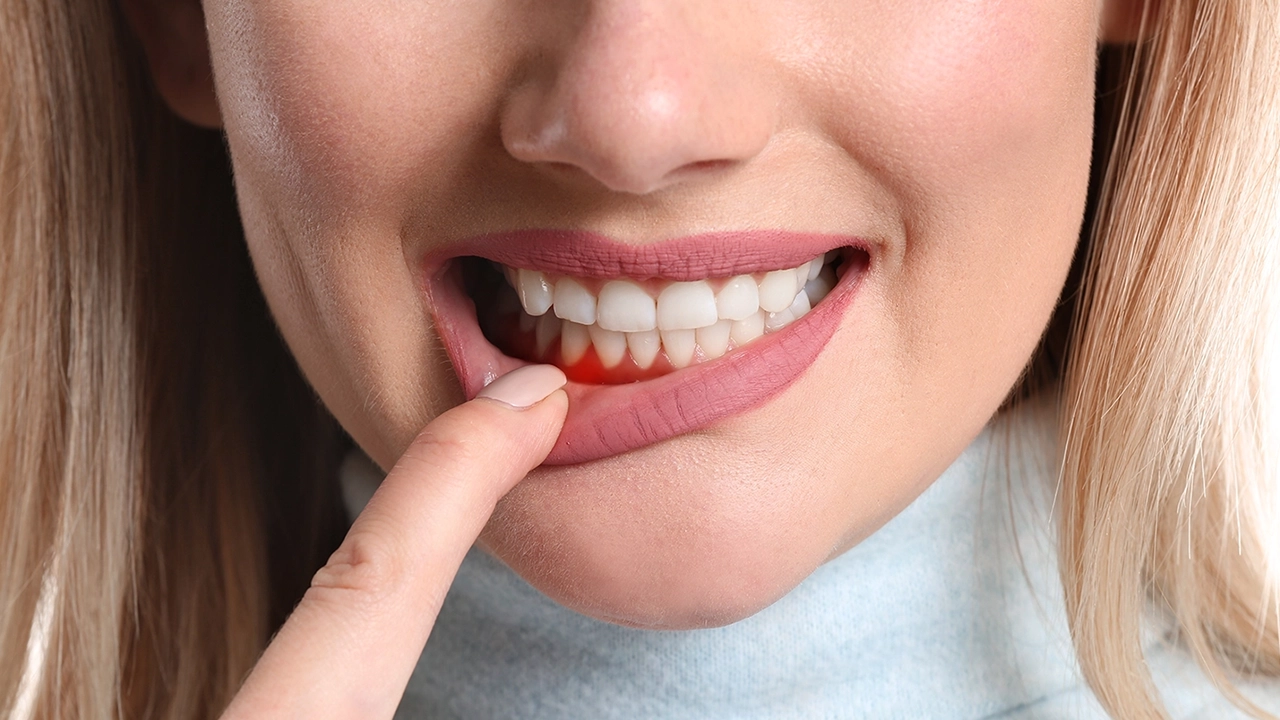 Bleeding Gums: The #1 Overlooked Sign of Gum Disease