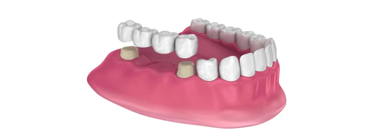 Dental Bridges