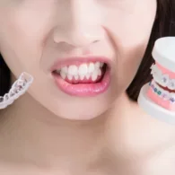 How Long Does Invisalign Take For Crowded Teeth?