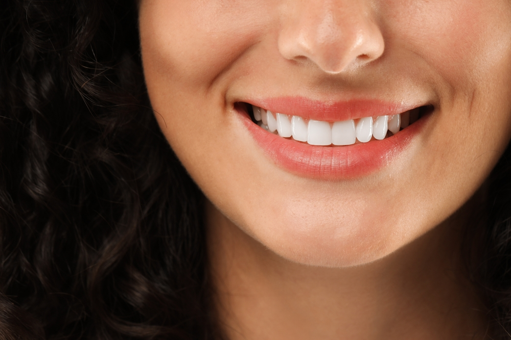 White Veneers