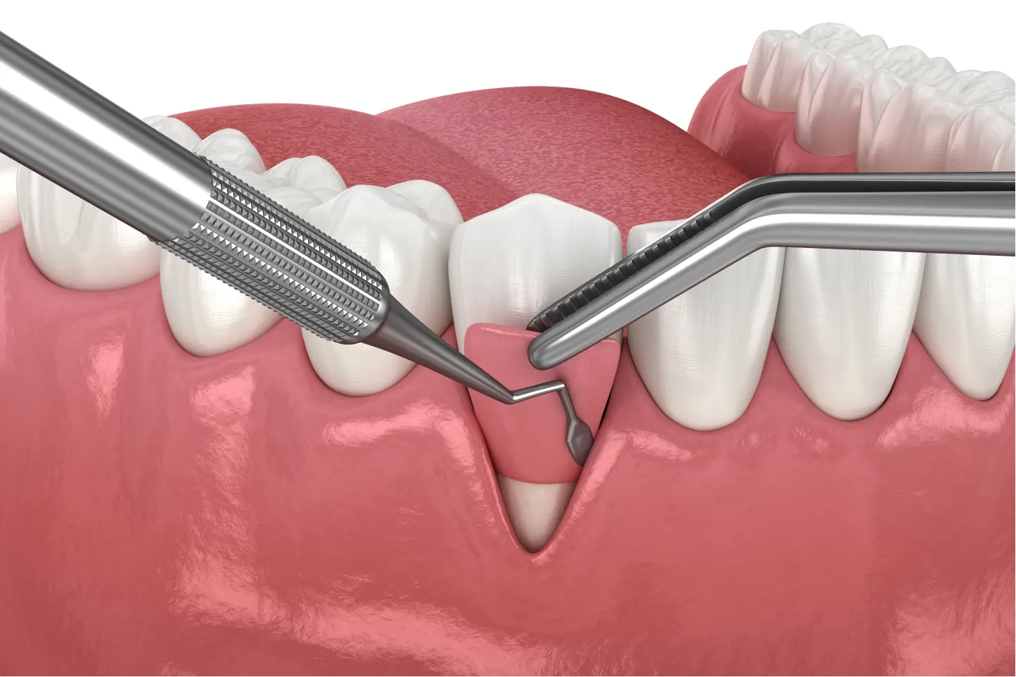 Gum graft