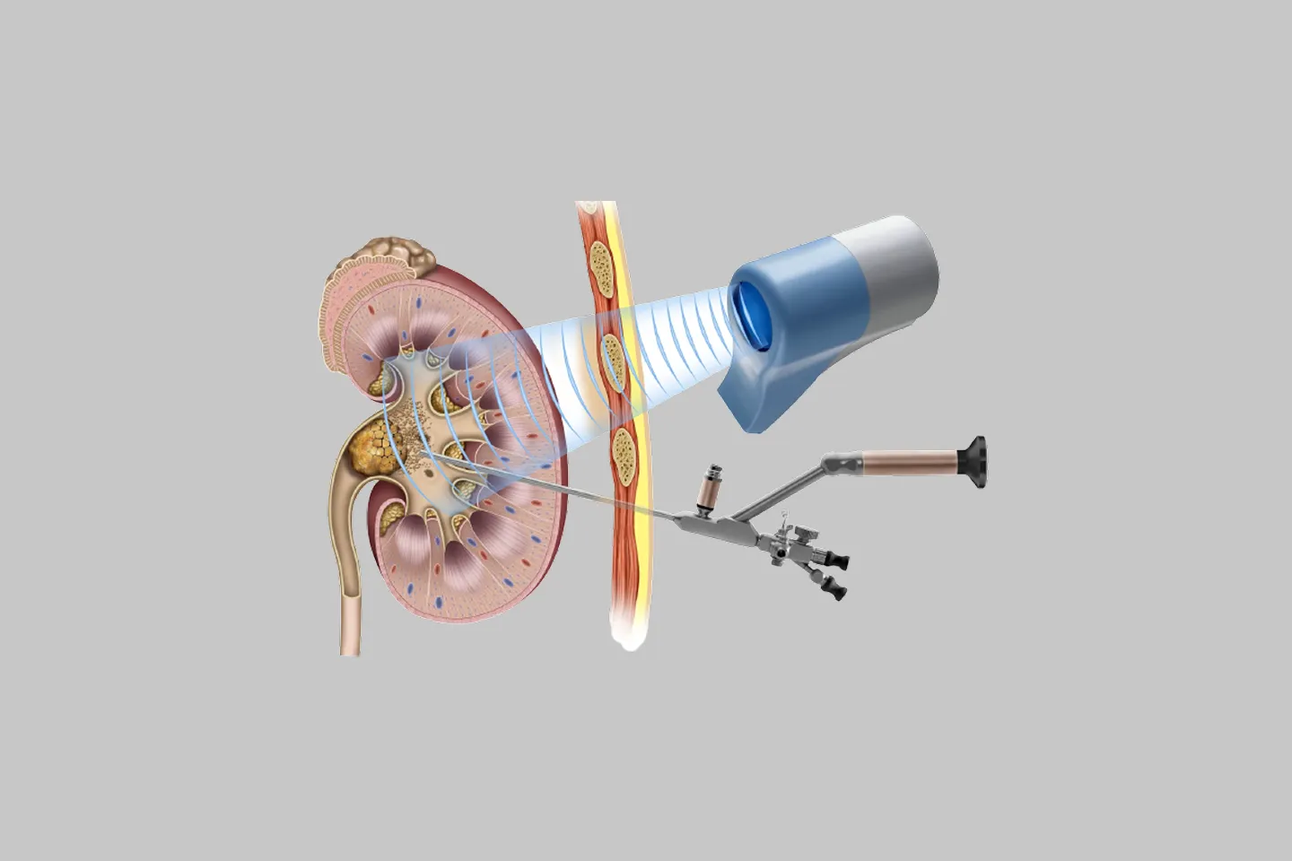 LASER Stone Surgeries (without incision/cut) for