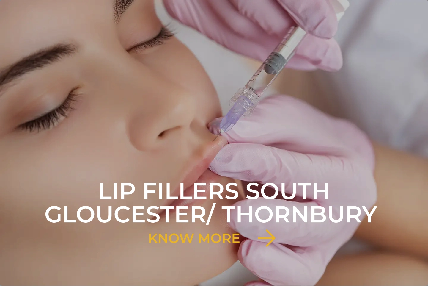 Lip fillers South Gloucester/ Thornbury 