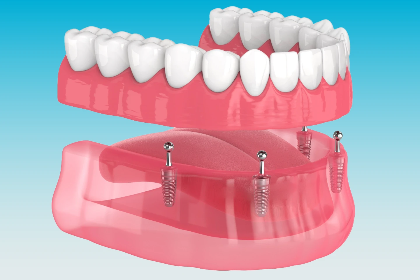 Retained Dentures image