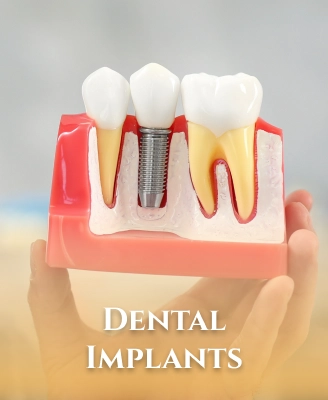 Dental Bridges vs. Implants: Which One Is Right for You?