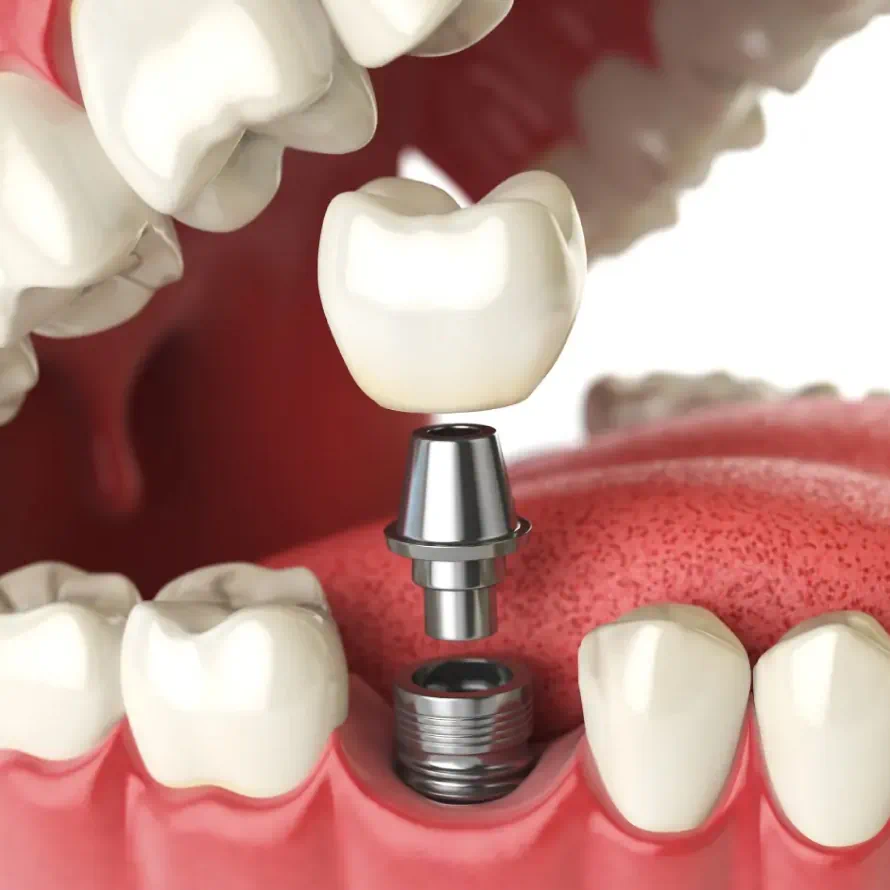 Restore Your Smile with Dental Implants