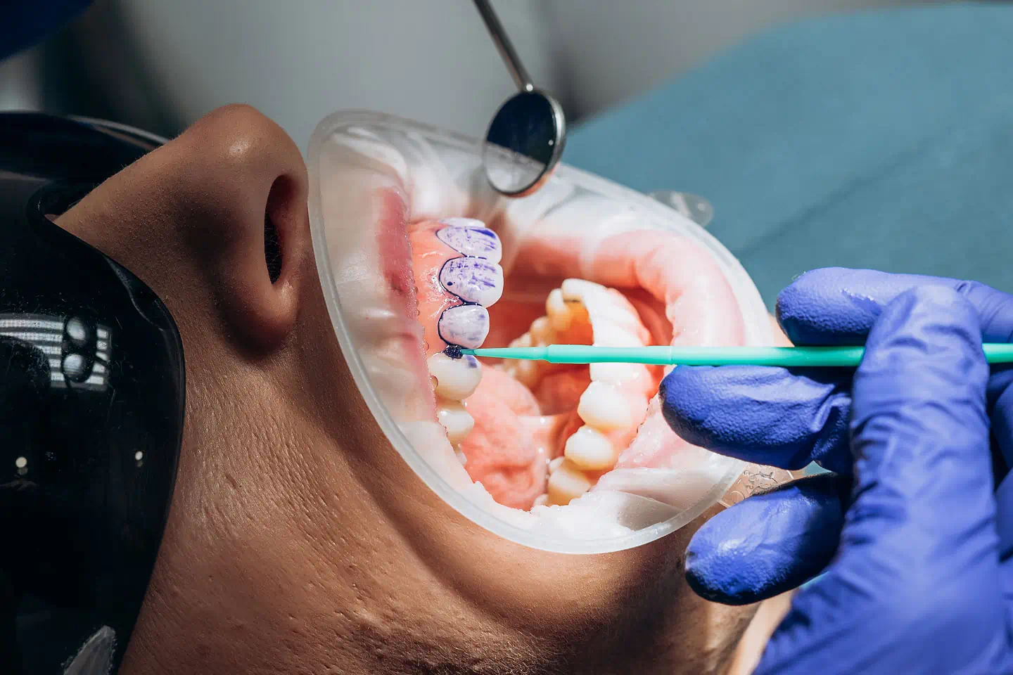 Fluoride Treatment