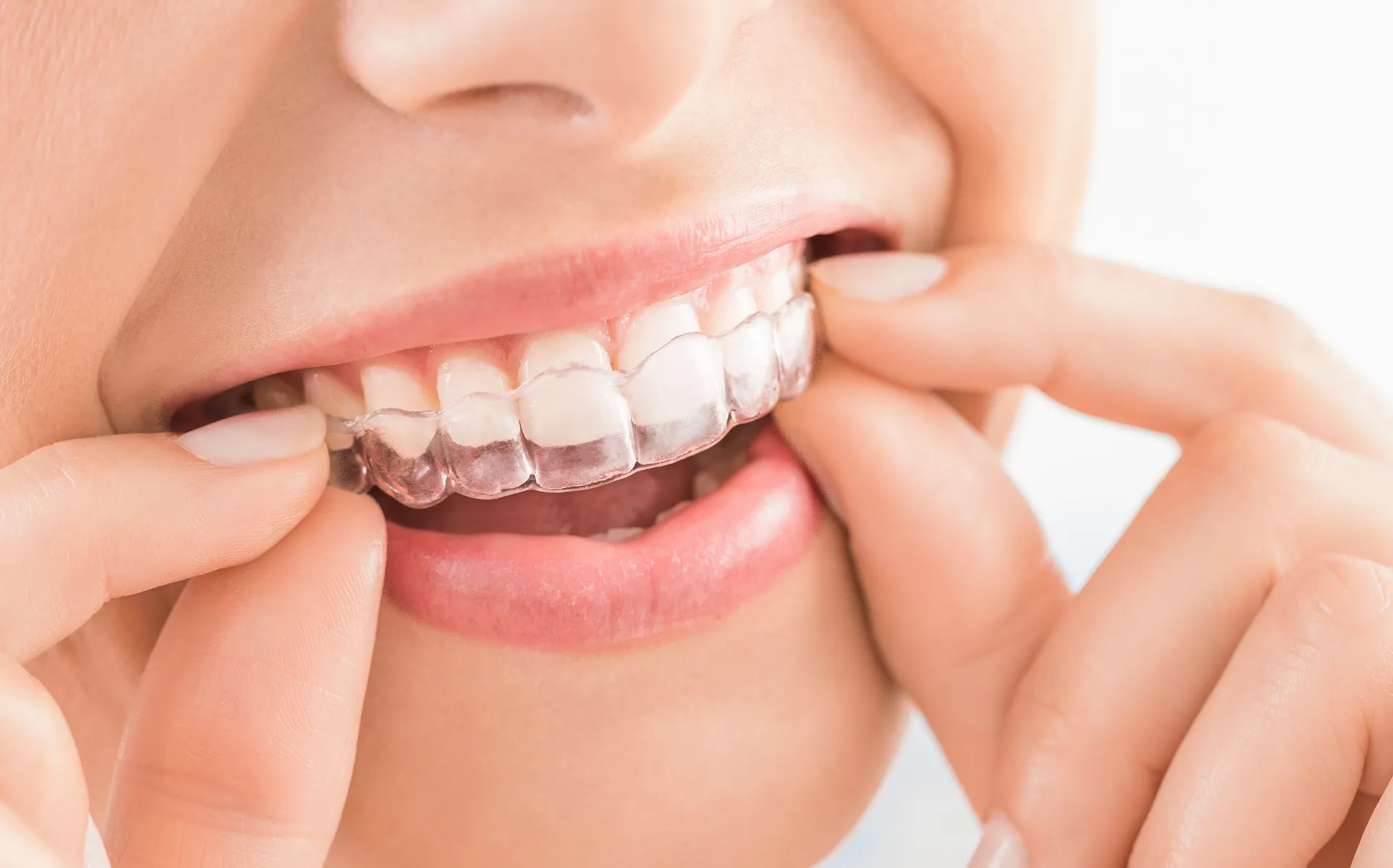 Invisalign Treatment 