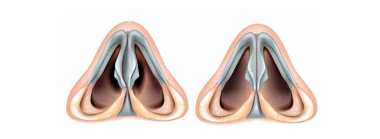 Turbinoplasty/Turbinectomy