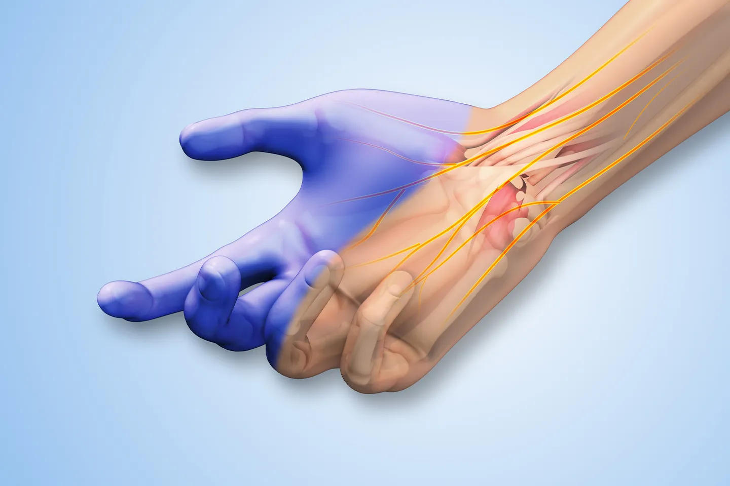 Peripheral Nerve Entrapment (e.g., Cubital Tunnel Syndrome)