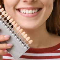 How Much for Full Set of Veneers? – The Cost Estimation