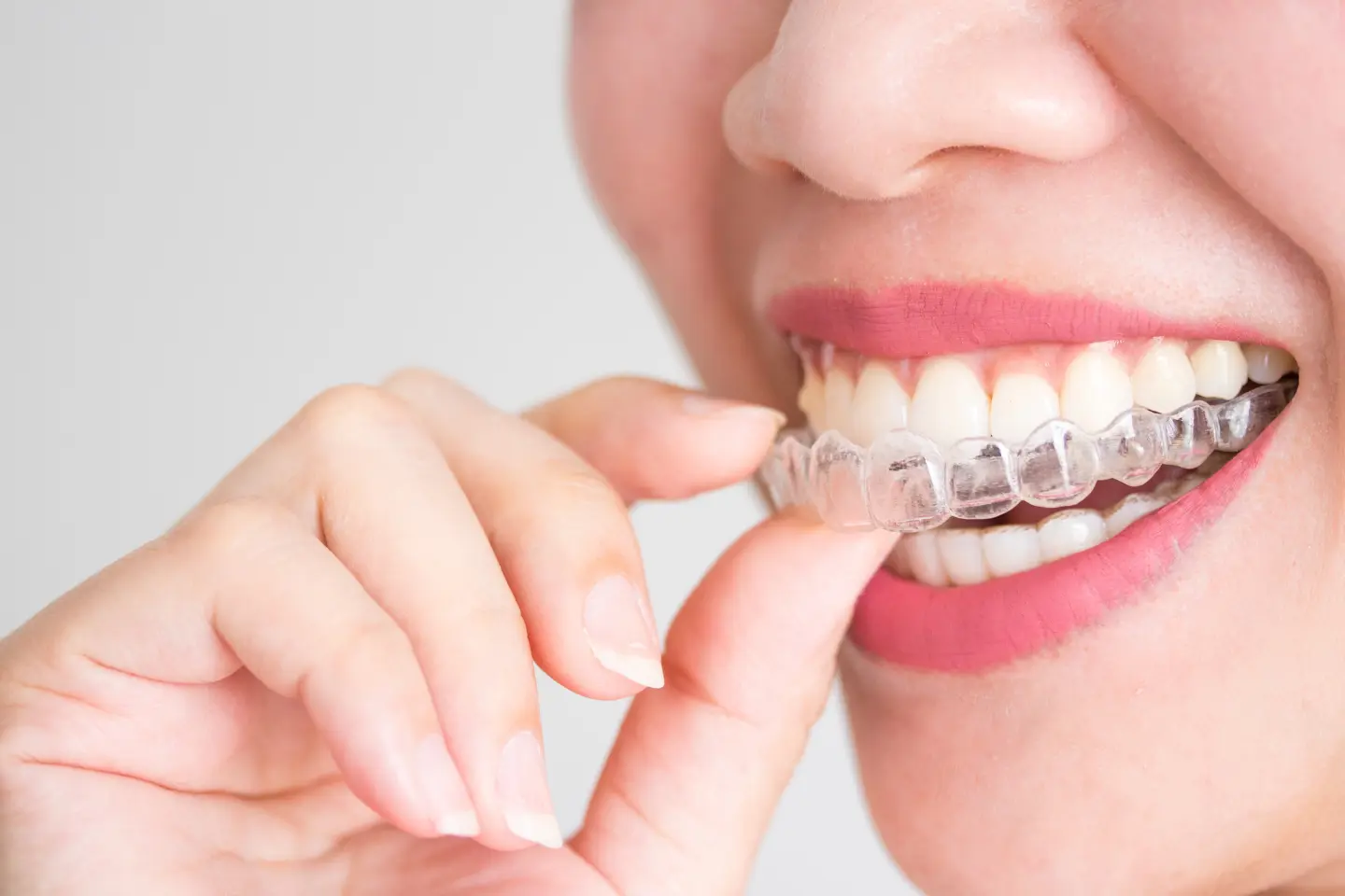Digital Smile Design with Invisalign in Medford, MA: What to Expect