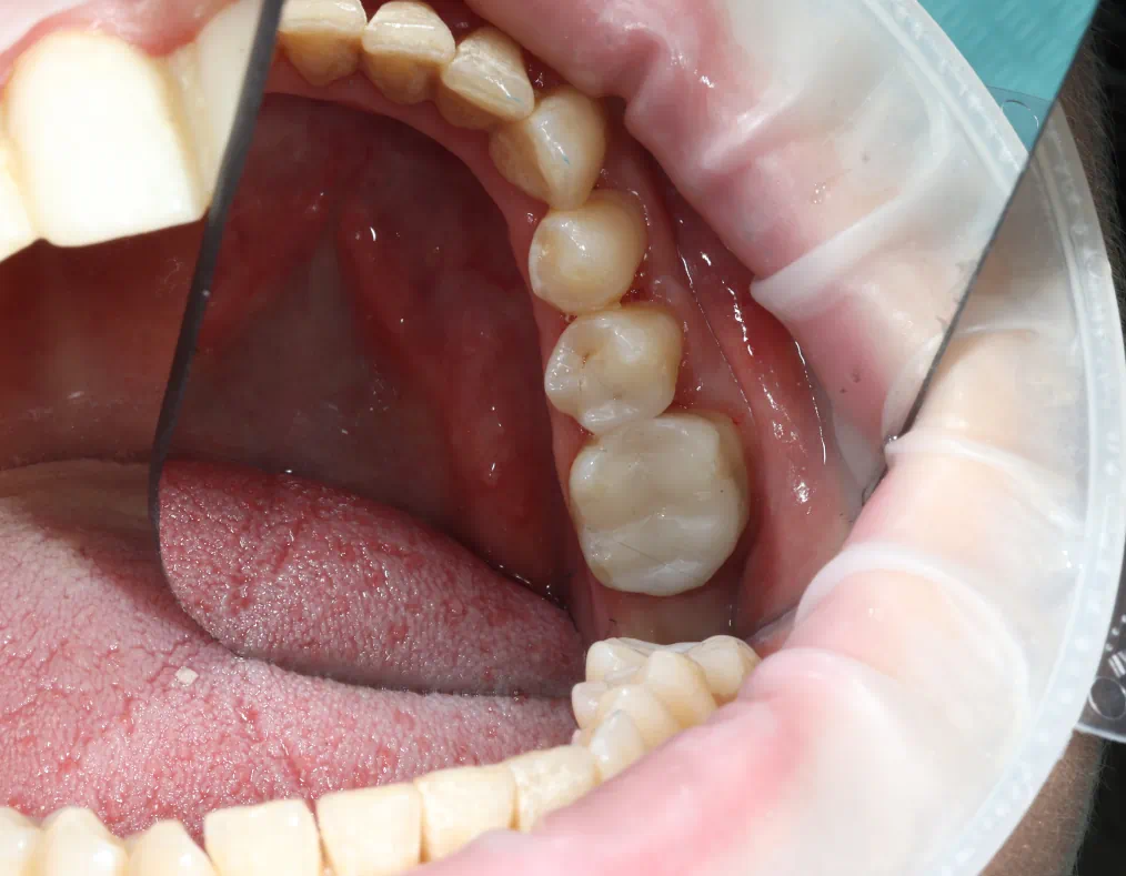 White Fillings