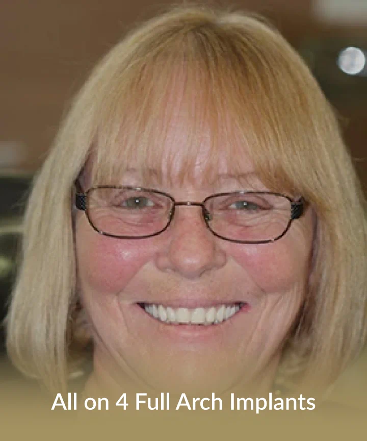 All on 4 arch implants