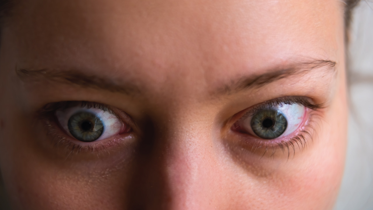 Patient with thyroid eye disease showing eye bulging before treatment.