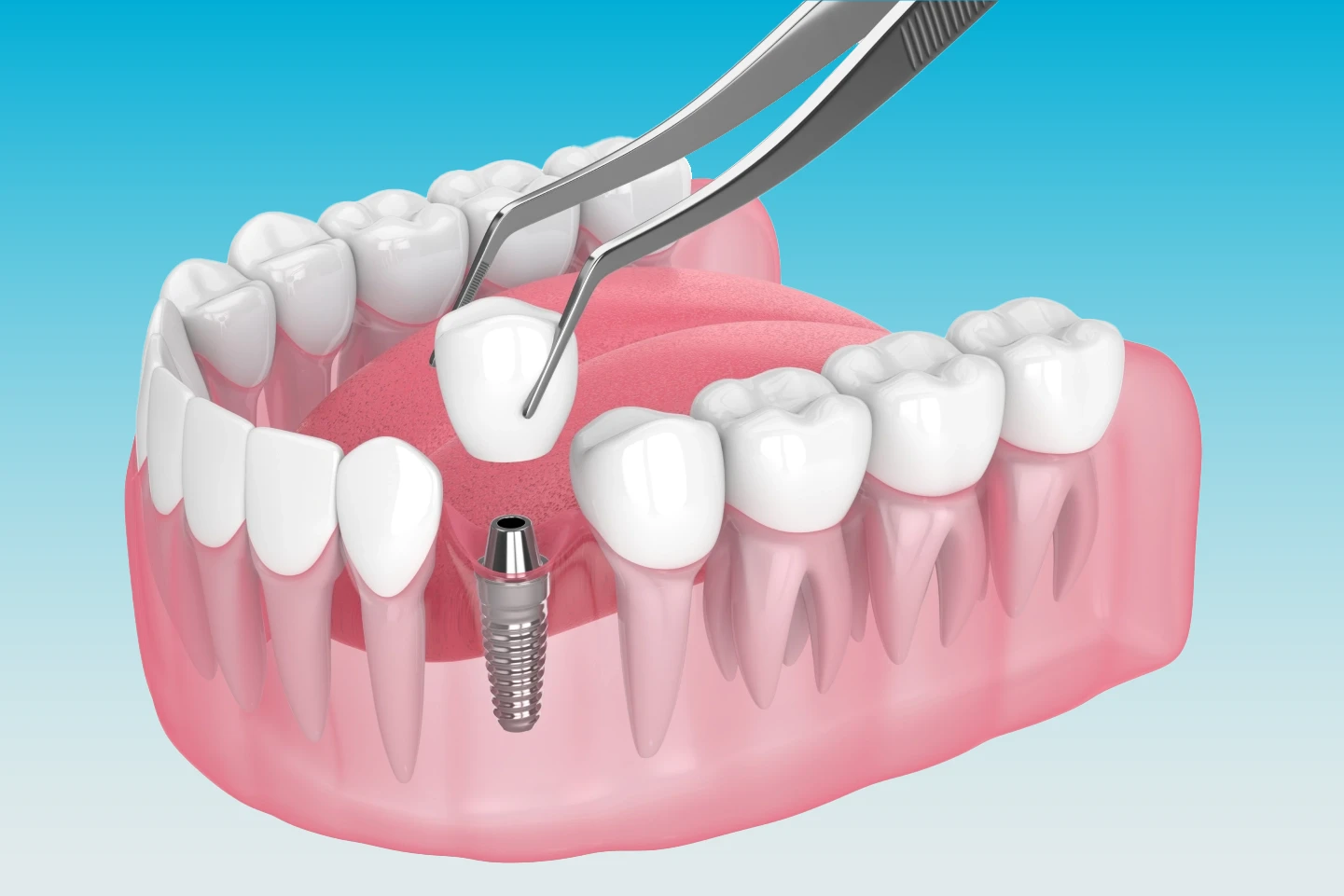 Dental Implant image