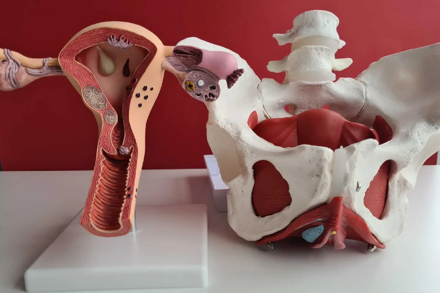 Vaginal hysterectomy +pelvic floor repair