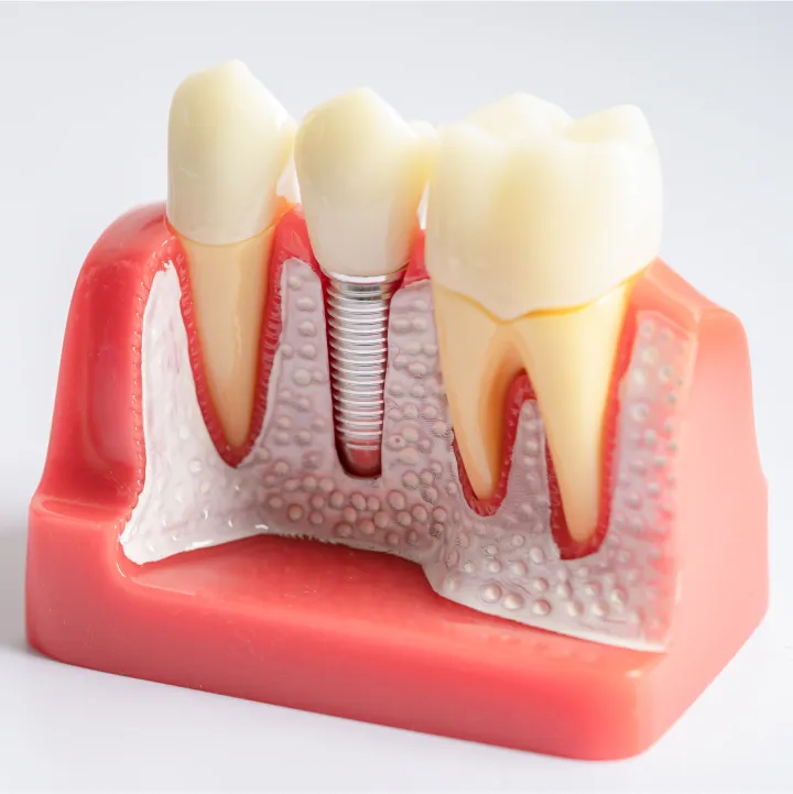 Dental Implant