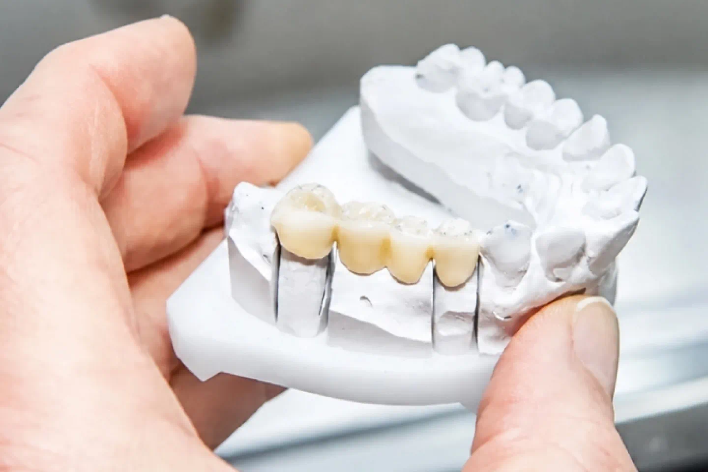 Dental Bridges in South Miami