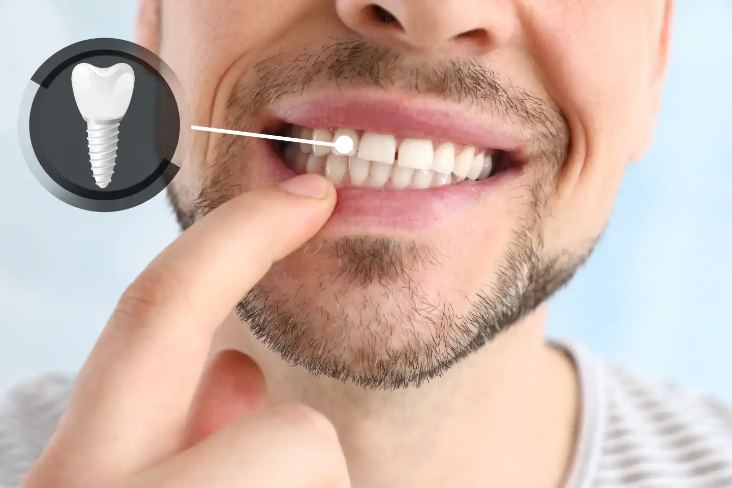 Dental Implant Post-Op Care in Manteca, CA