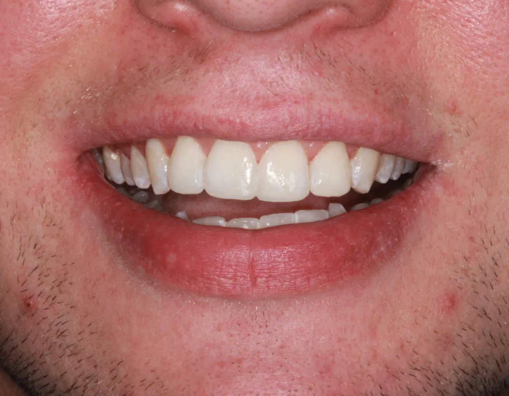 Teeth Whitening