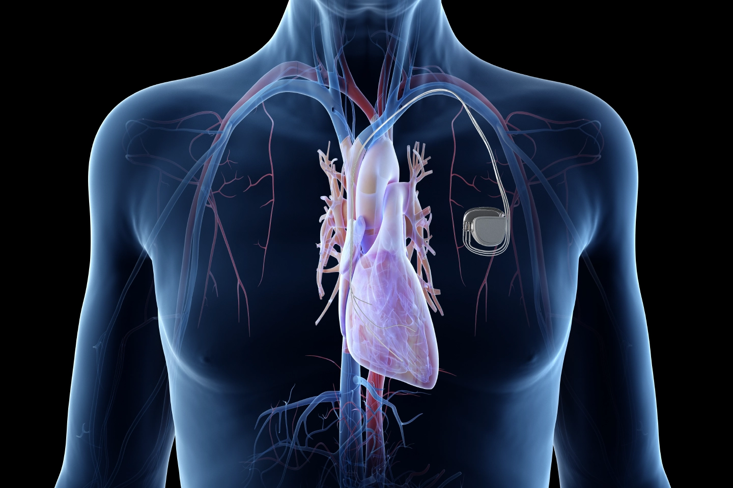 Device implantation