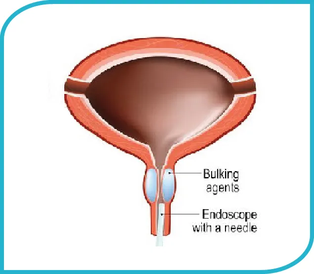 Urinary Continence Procedures-