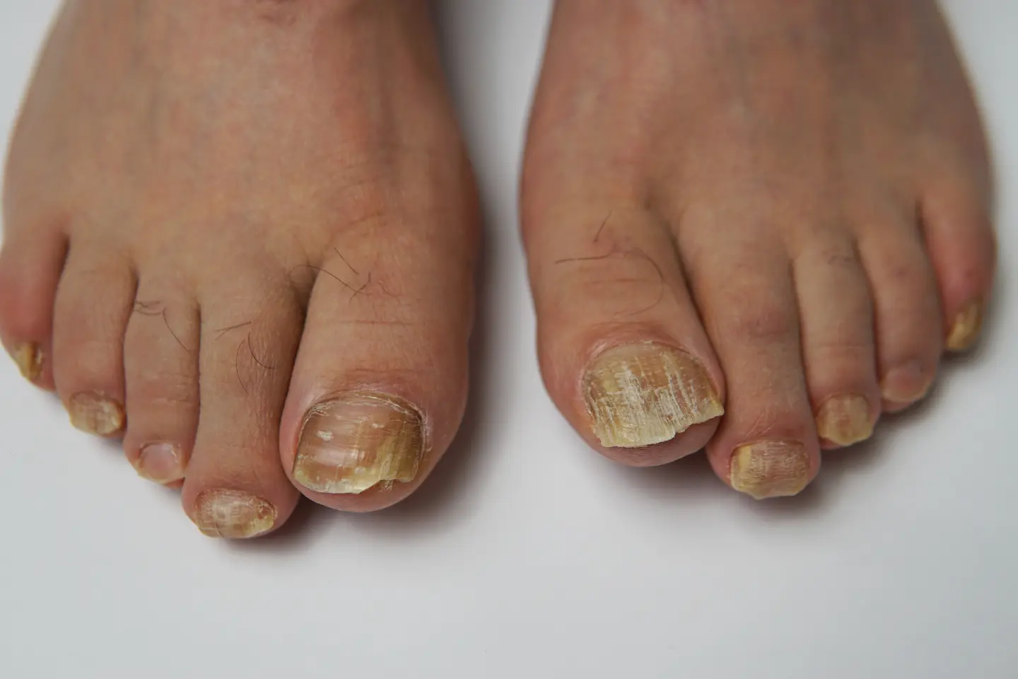 Close-up of a person's foot receiving laser treatment for toenail fungus at a medical spa.