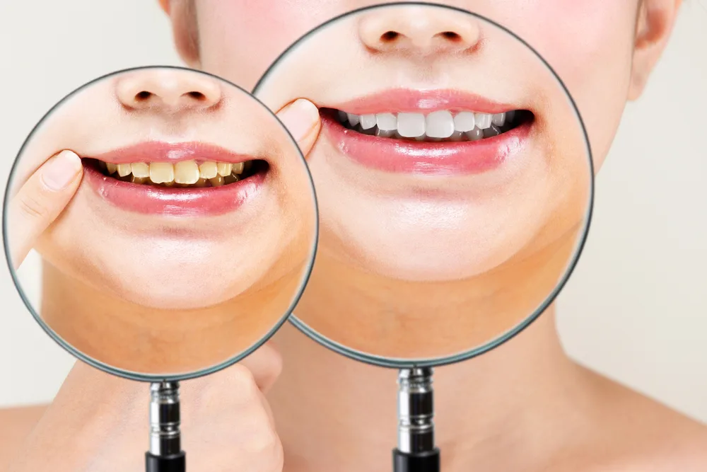 DIY Teeth Whitening Risks