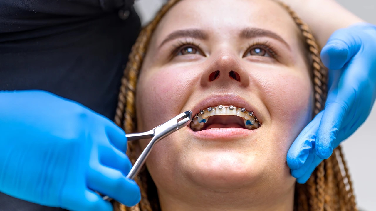 types of braces dental illustration