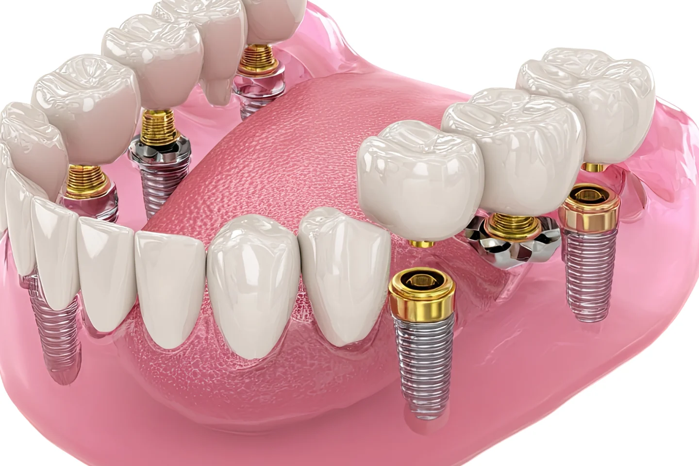 All-on-6 Dental Implants in Manteca, CA 
