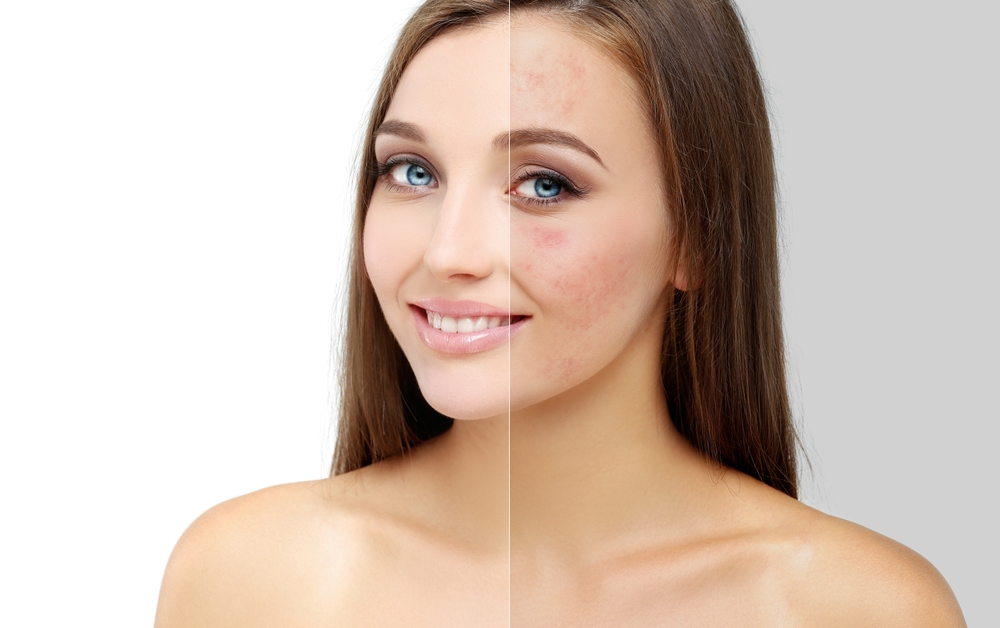 Acne Scars and Pigmentation