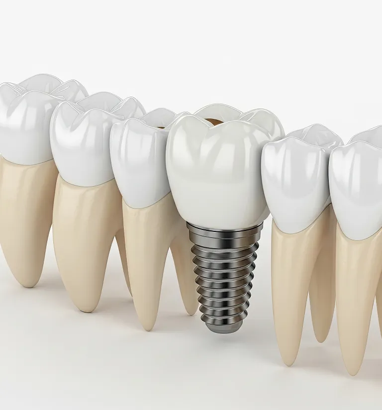 Single Tooth Implant