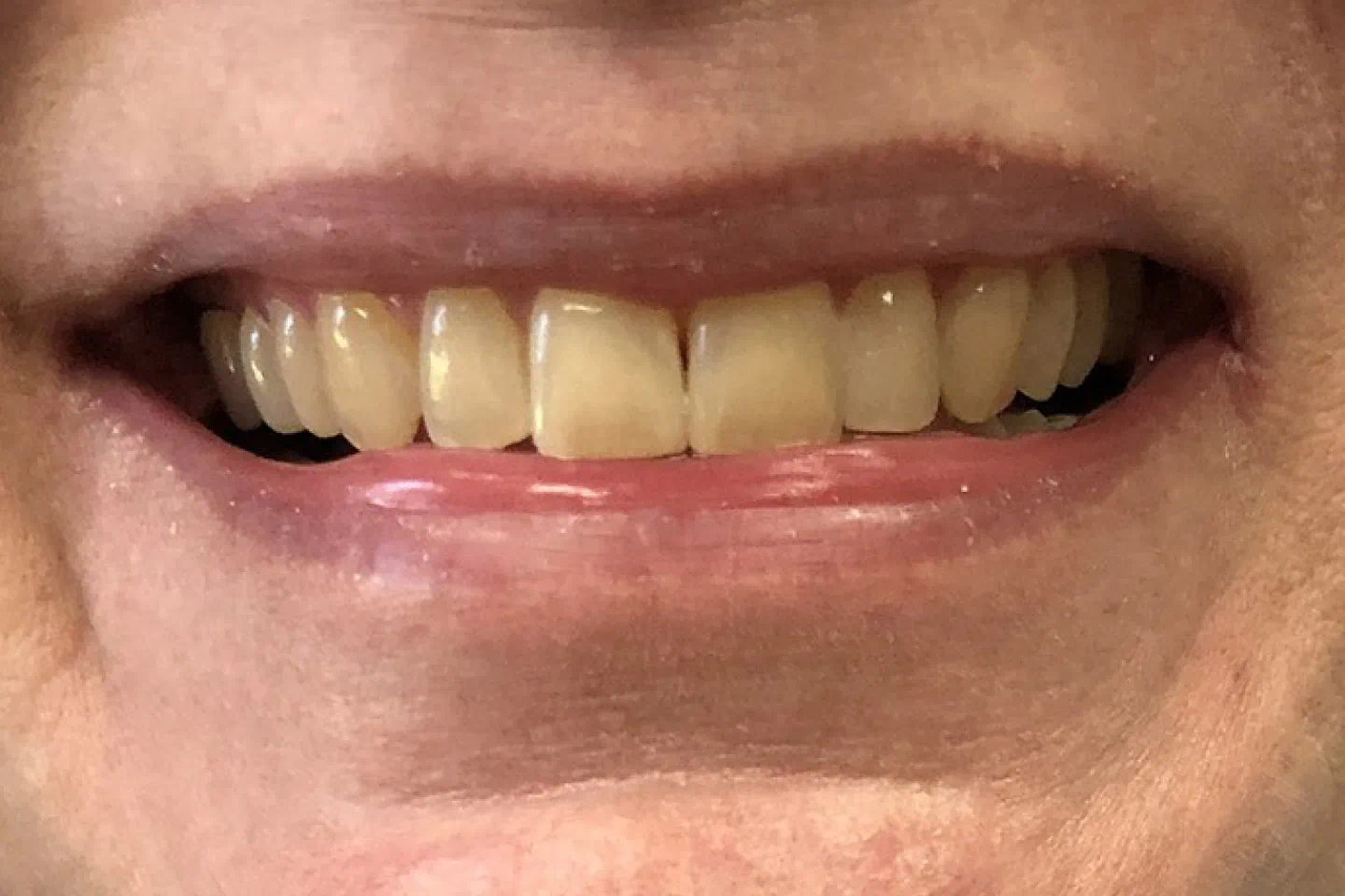 Improved smile results after Invisalign® treatment