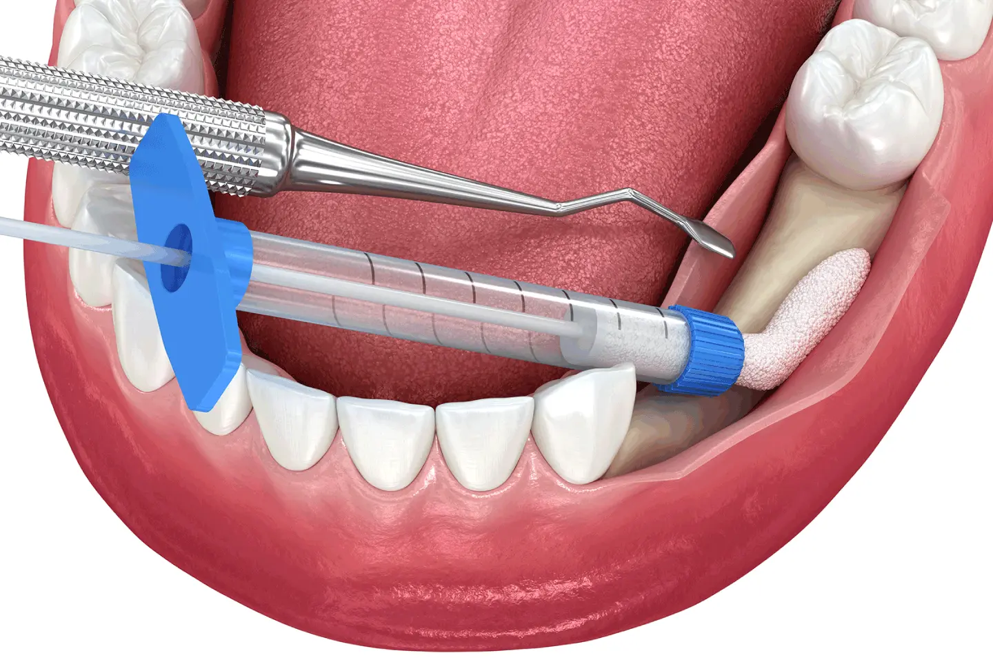 Will I Need a Bone Graft for Dental Implants - Gauri Savant, DDS