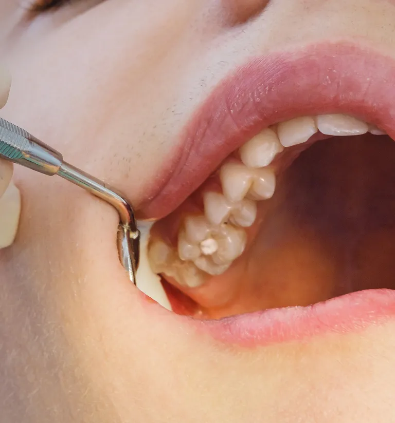 Single Tooth Implant