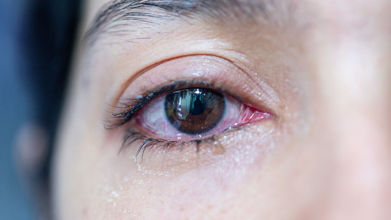 Understanding Watery Eyes and DCR Surgery