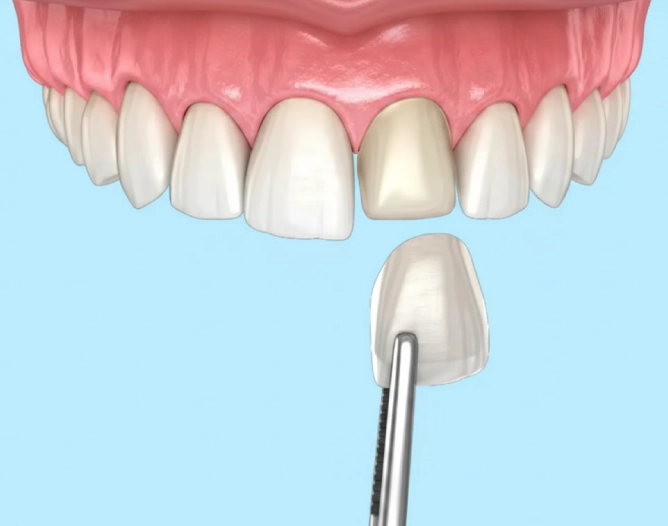 Veneers