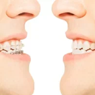 How Much is Six Month Smiles?