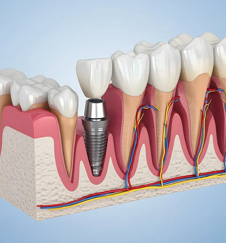 Single Tooth Replacement Options