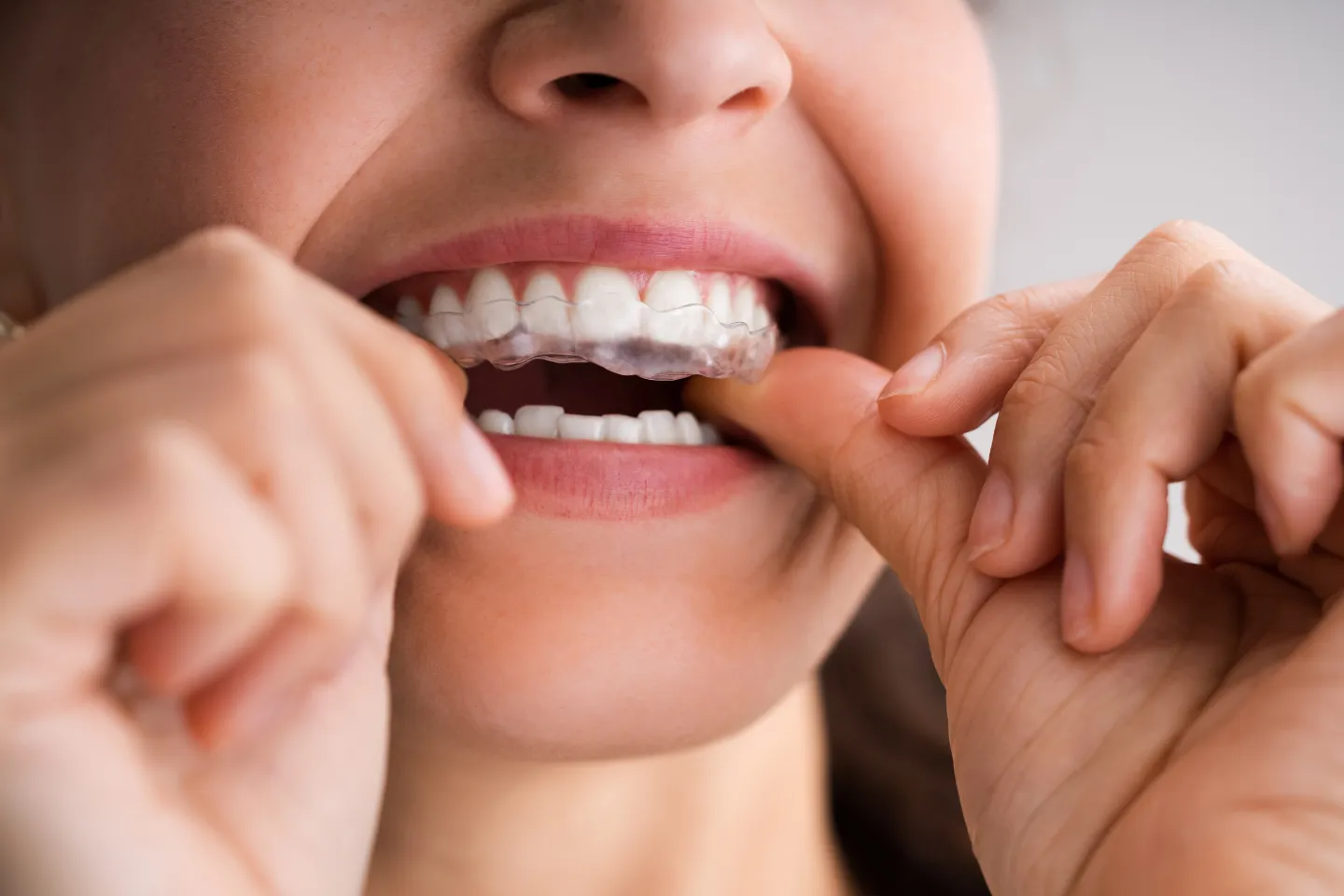 Invisalign at SoFlo Denta