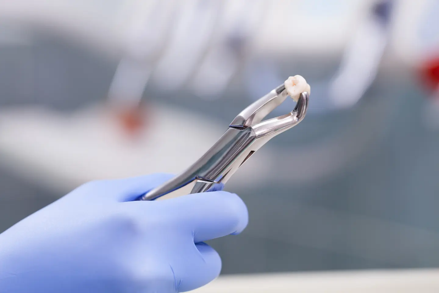 Navigating Tooth Extractions