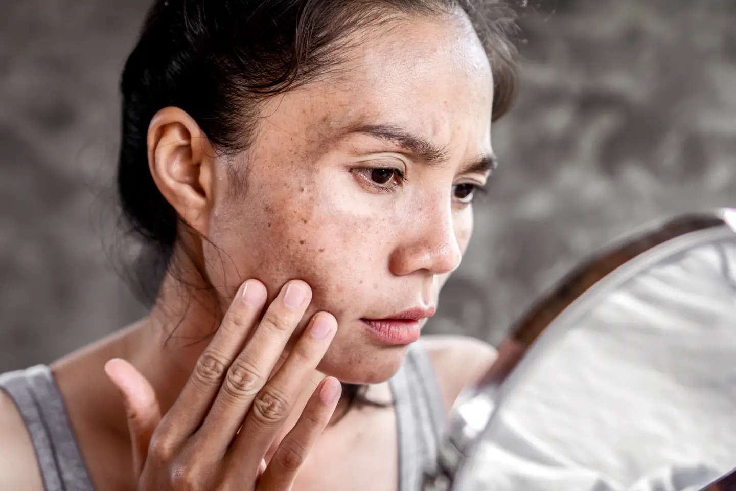 Mistakes People Make When Trying to Treat Melasma