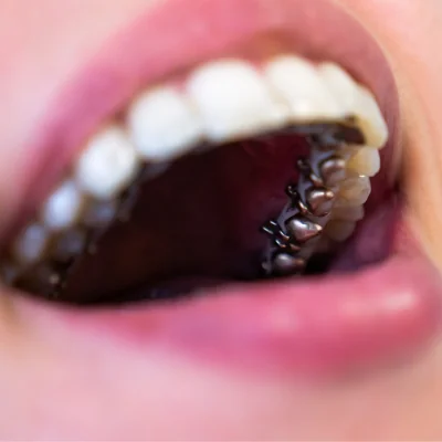 Invisible Teeth Straightening Options: Achieving a Perfect Smile Discreetly