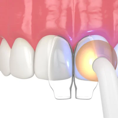 Transforming Smiles in Leicester with Minimally Invasive Dentistry