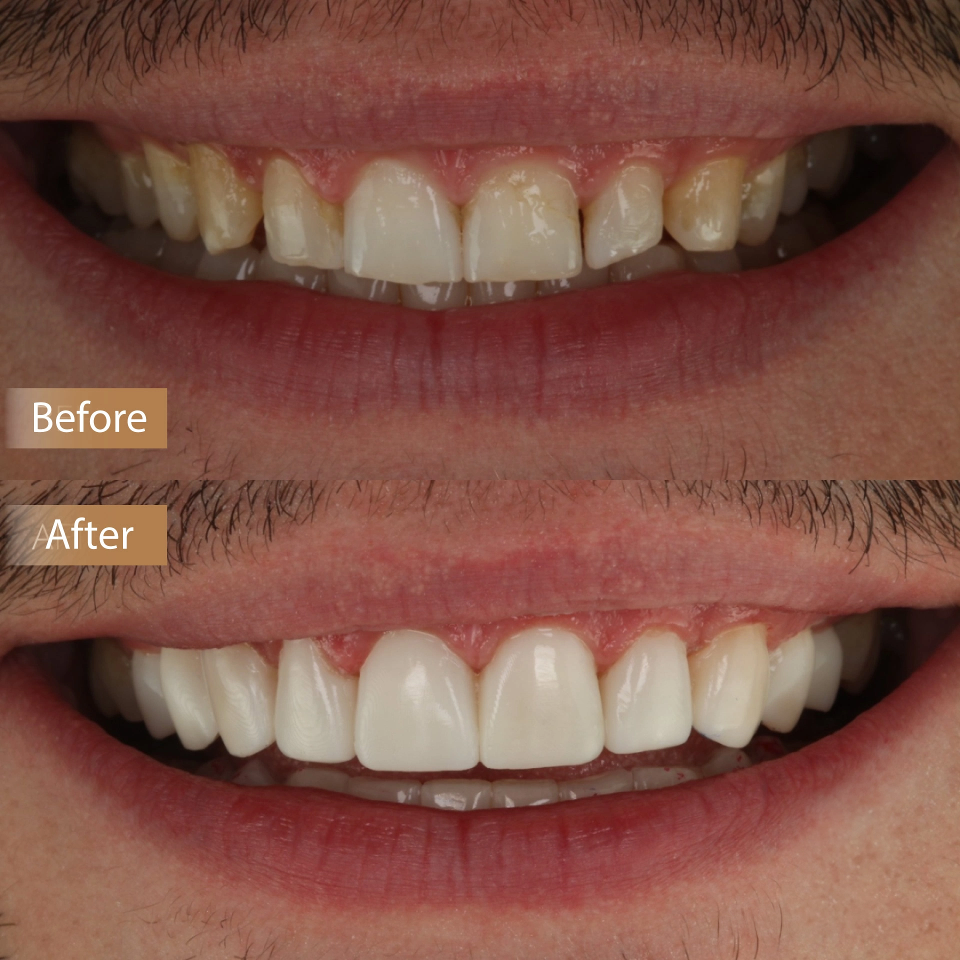 Composite Veneers