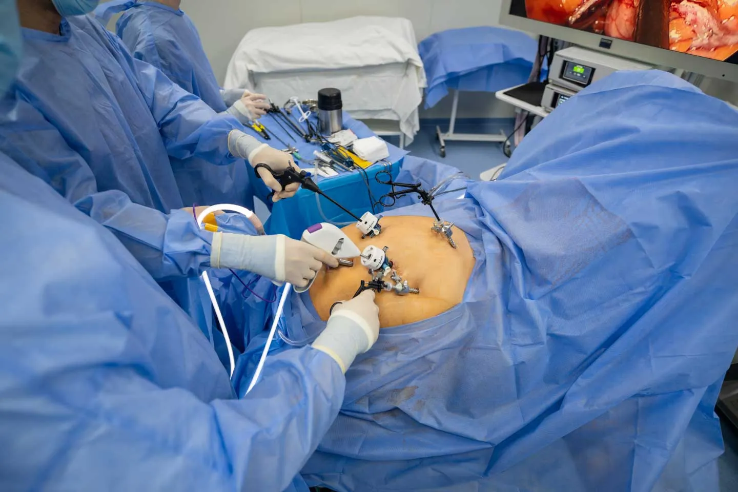 Laparoscopic Surgery for Diverticulitis