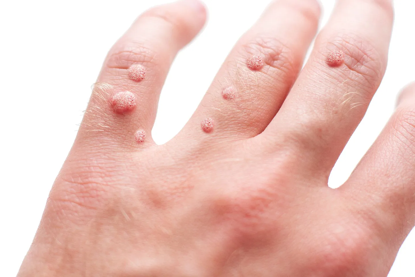 Small & grainy skin growths that occur most often on your fingers or hands.
